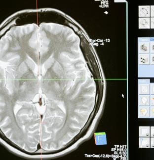 IRM du cerveau